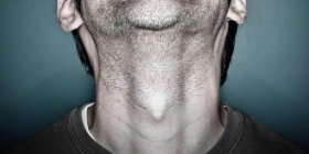 Nódulos: Homens também são propensos ao câncer de tireoide