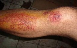 Adolescente é atropelado enquanto jogava Pokémon GO, em Jaru
