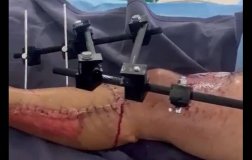 Cirurgias reconstroem perna dilacerada de aluno de 9 anos e prefeito manda...
