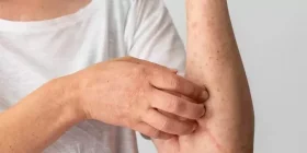 Brasil contabiliza 1,5 mil casos de mpox em 2024