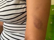 Mulher é atacada a capacetadas pelo marido durante bebedeira, em Porto Velho