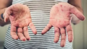 Agevisa investiga caso suspeito de sarampo em Rondônia