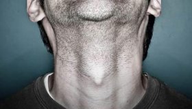 Nódulos: Homens também são propensos ao câncer de tireoide