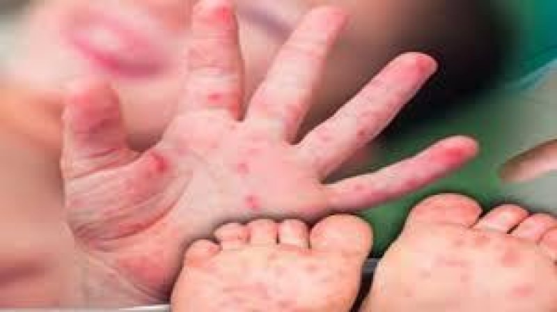 Registrados pelo menos 100 casos da doença mão-pé-boca em Rolim de Moura