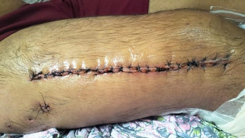 Foto 3 da matéria: AJUDA: Jovem de Migrantinópolis precisa arrecadar mais de R$ 45 mil reais para pagar cirurgias