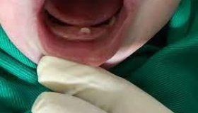 Bebê nasce com dente e chama a atenção de profissionais no HR de Vilhena