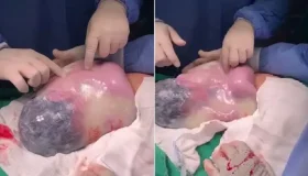 Bebê nasce empelicado e vídeo mostra médico