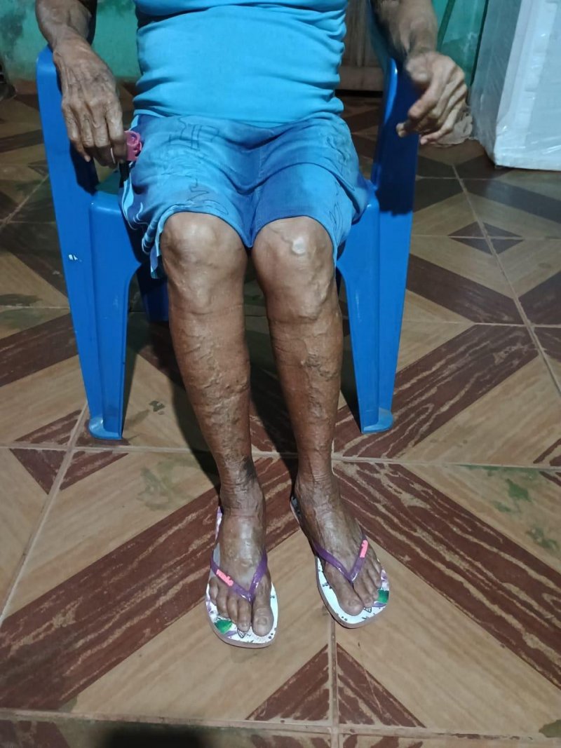 URGENTE: Idosa de Rolim de Moura precisa arrecadar R$ 11 mil para realizar cirurgia nas pernas