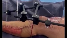 Cirurgias reconstroem perna dilacerada de aluno de 9 anos e prefeito manda...