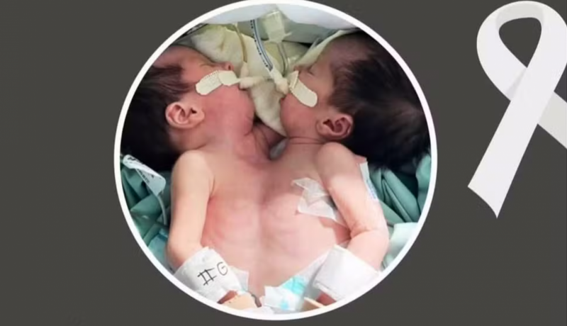 Gêmeas siamesas, Nathaly e Rhadassa — Foto: Redes Sociais/Reprodução