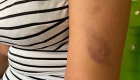 Mulher é atacada a capacetadas pelo marido durante bebedeira, em Porto Velho