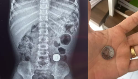 Criança de 3 anos engole bateria de lítio e é internada com dor abdominal em...