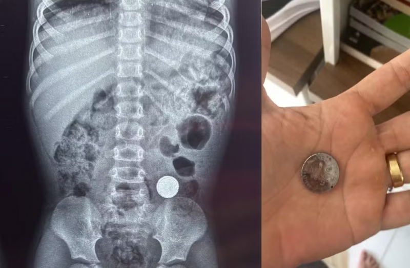 Criança de 3 anos engole bateria de lítio e é internada com dor abdominal em Ji-Paraná