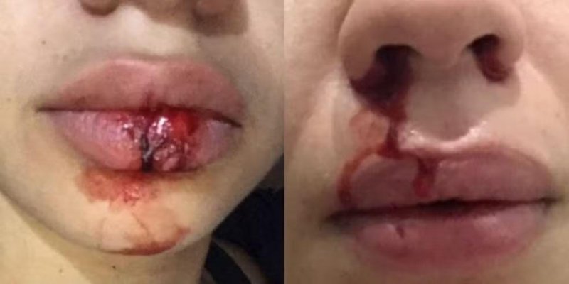 hematomas na vítima após as agressões físicas