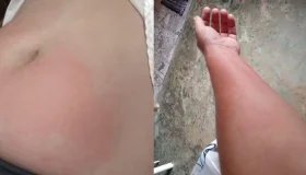 Alergia à água: rondoniense luta contra doença rara que transforma até o...