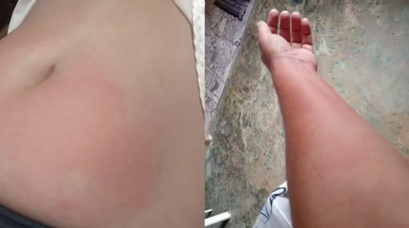 Alergia à água: rondoniense luta contra doença rara que transforma até o suor em risco