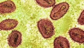 Mais dois casos de mpox são confirmados em Rondônia; total sobe para seis
