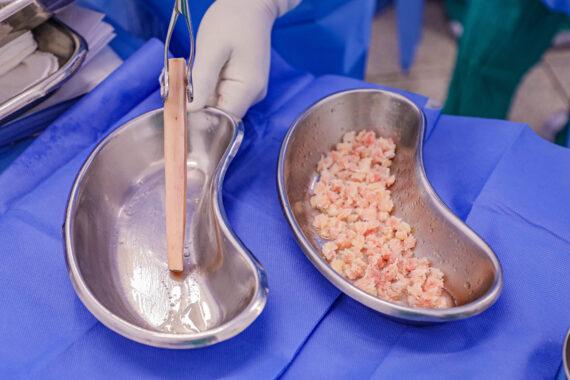 Rondônia faz primeiro transplante ósseo do Norte; entenda como funciona cirurgia que usa 