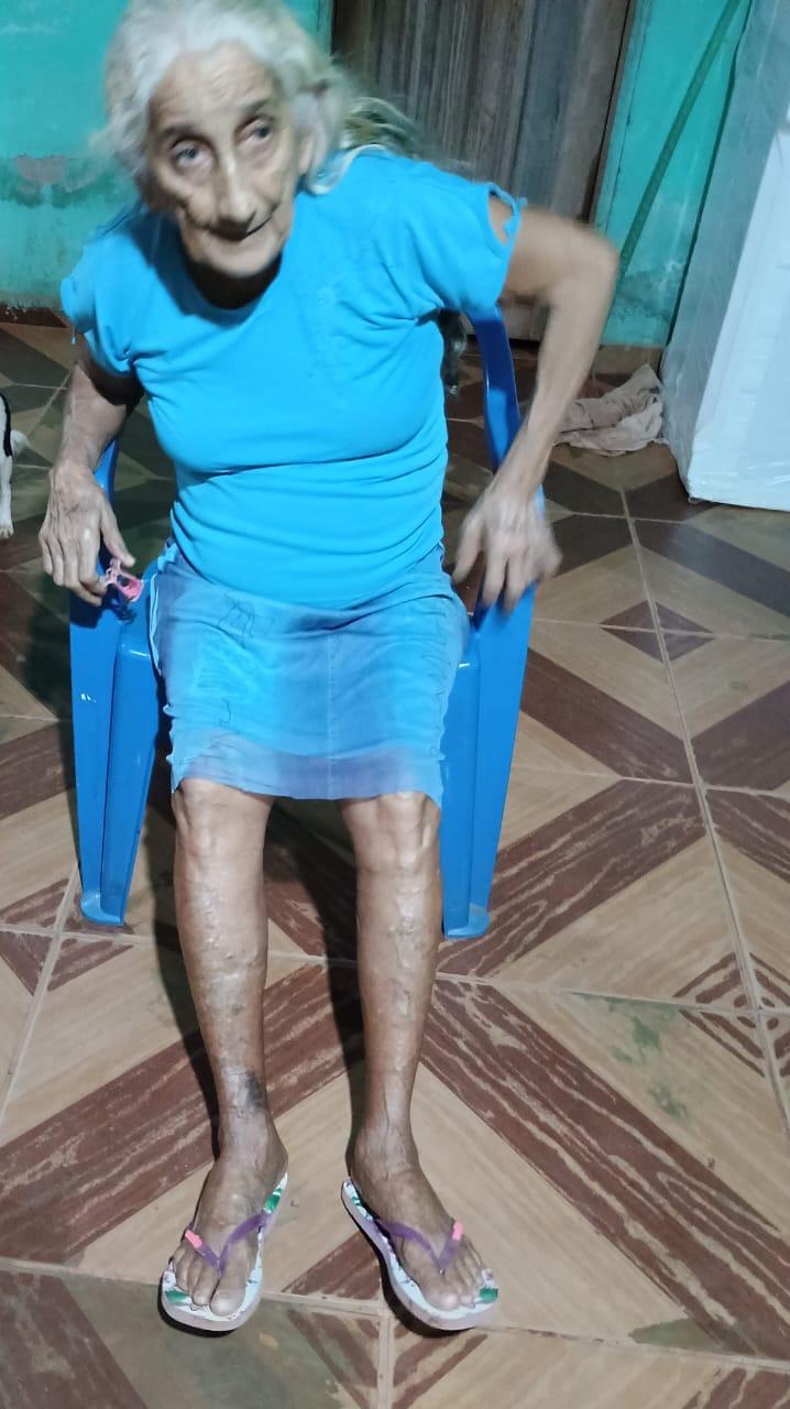 URGENTE: Idosa de Rolim de Moura precisa arrecadar R$ 11 mil para realizar cirurgia nas pernas
