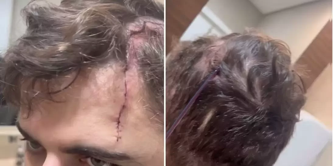 No hospital, Zé Neto mostra tamanho do corte na cabeça após acidente em kart: 